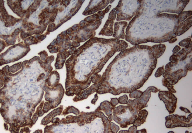 mabpro-mesothelioma